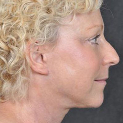 Ponytail Facelift before and after, case 31, view 4 (after)