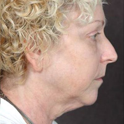 Ponytail Facelift before and after, case 31, view 4 (before)