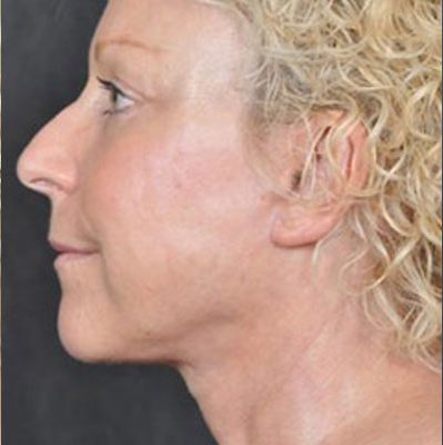 Ponytail Facelift before and after, case 31, view 5 (after)