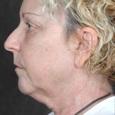 Ponytail Facelift before and after, case 31, view 5 (before)