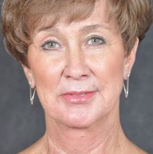 Ponytail Facelift before and after, case 32 (after)