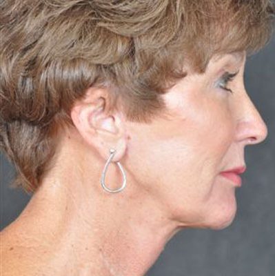 Ponytail Facelift before and after, case 32, view 3 (after)