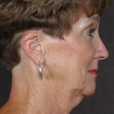 Ponytail Facelift before and after, case 32, view 3 (before)