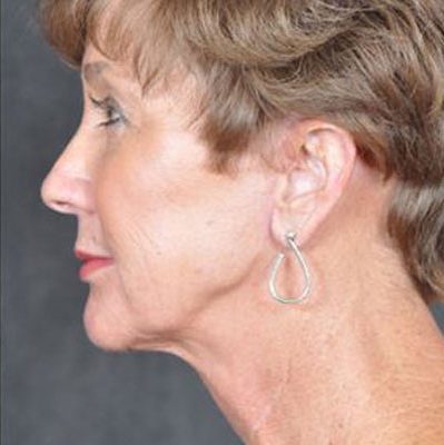 Ponytail Facelift before and after, case 32, view 5 (after)
