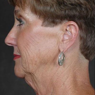 Ponytail Facelift before and after, case 32, view 5 (before)