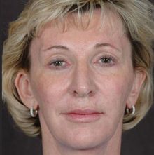 Ponytail Facelift before and after, case 33 (after)