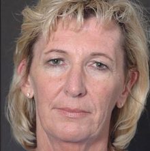 Ponytail Facelift before and after, case 33 (before)