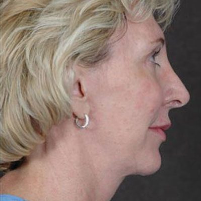 Ponytail Facelift before and after, case 33, view 3 (after)