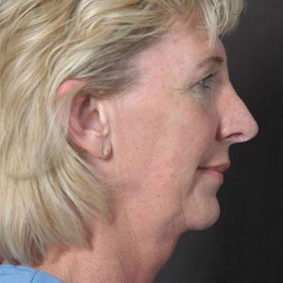 Ponytail Facelift before and after, case 33, view 3 (before)