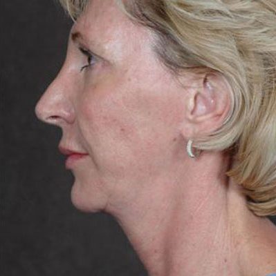 Ponytail Facelift before and after, case 33, view 5 (after)