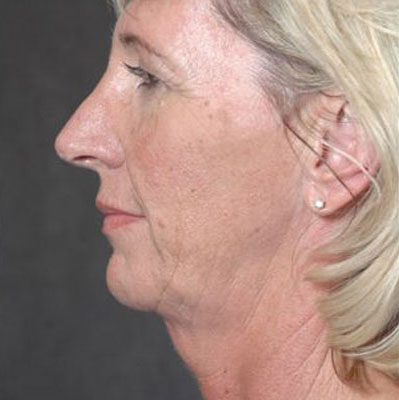 Ponytail Facelift before and after, case 33, view 5 (before)