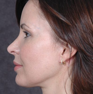 Ponytail Facelift before and after, case 34, view 4 (after)