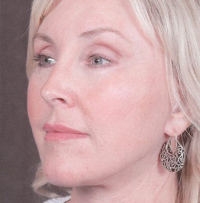 Ponytail Facelift before and after, case 35, view 3 (after)