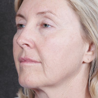 Ponytail Facelift before and after, case 35, view 3 (before)