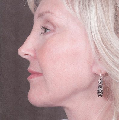 Ponytail Facelift before and after, case 35, view 4 (after)