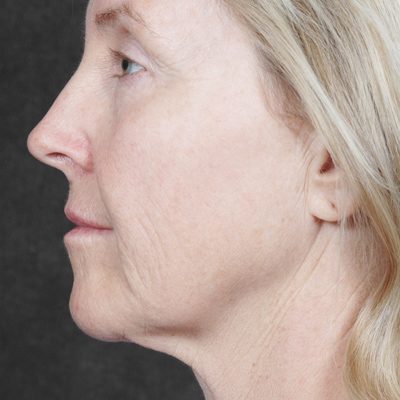 Ponytail Facelift before and after, case 35, view 4 (before)