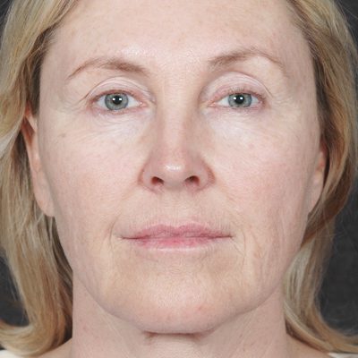 Ponytail Facelift before and after, case 35, view 5 (before)