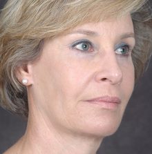 Ponytail Facelift before and after, case 36 (after)