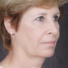 Ponytail Facelift before and after, case 36 (before)