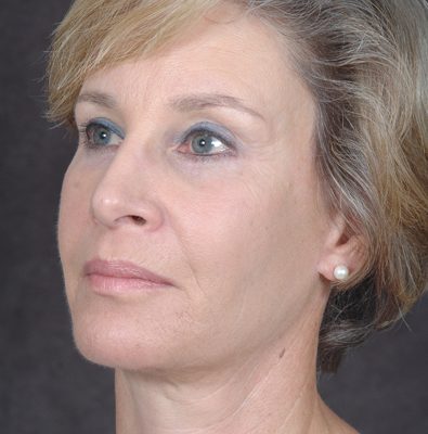 Ponytail Facelift before and after, case 36, view 3 (after)