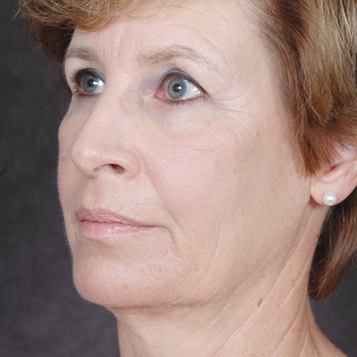 Ponytail Facelift before and after, case 36, view 3 (before)