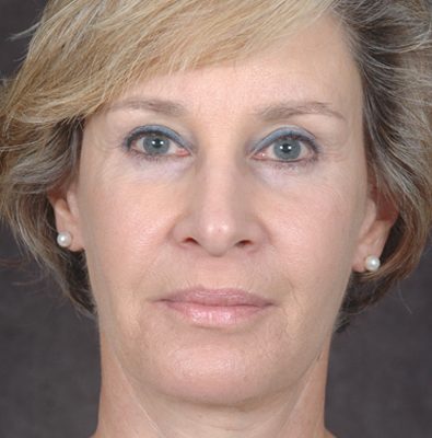 Ponytail Facelift before and after, case 36, view 4 (after)