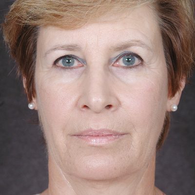 Ponytail Facelift before and after, case 36, view 4 (before)