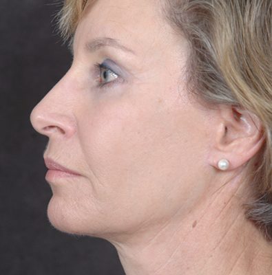 Ponytail Facelift before and after, case 36, view 5 (after)