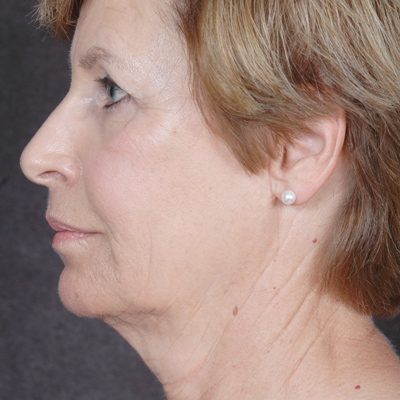 Ponytail Facelift before and after, case 36, view 5 (before)