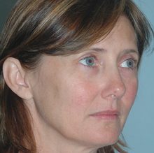 Ponytail Facelift before and after, case 37 (before)