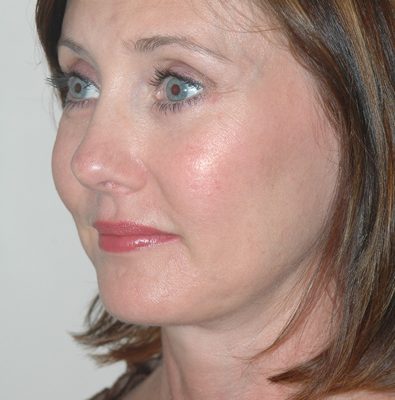 Ponytail Facelift before and after, case 37, view 3 (after)