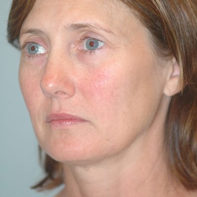 Ponytail Facelift before and after, case 37, view 3 (before)