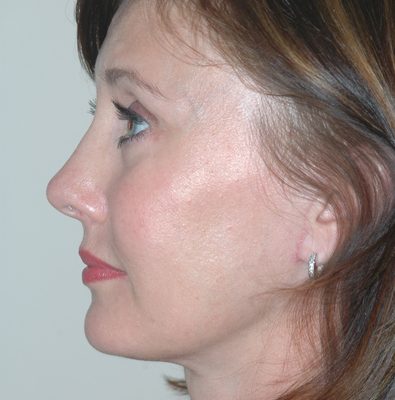 Ponytail Facelift before and after, case 37, view 4 (after)