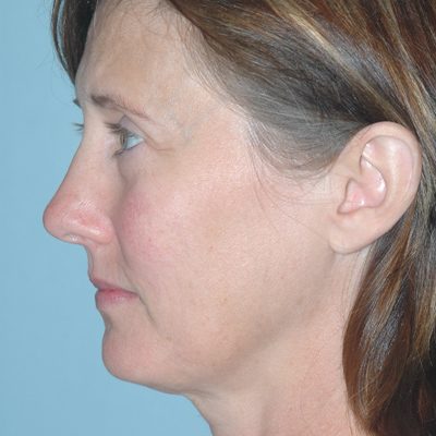 Ponytail Facelift before and after, case 37, view 4 (before)