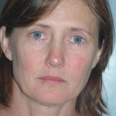 Ponytail Facelift before and after, case 37, view 5 (before)