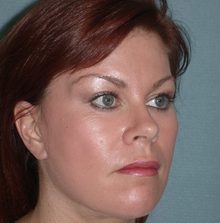 Ponytail Facelift before and after, case 38 (after)