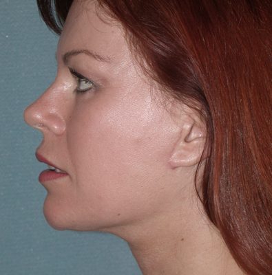 Ponytail Facelift before and after, case 38, view 4 (after)