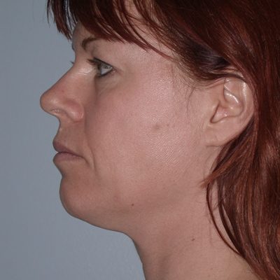 Ponytail Facelift before and after, case 38, view 4 (before)