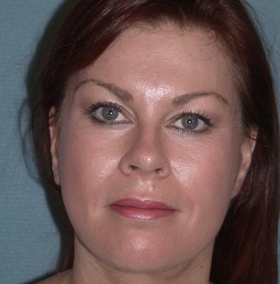 Ponytail Facelift before and after, case 38, view 5 (after)