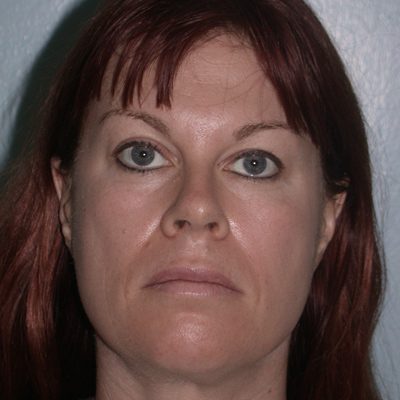 Ponytail Facelift before and after, case 38, view 5 (before)