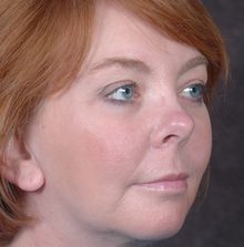 Ponytail Facelift before and after, case 39 (after)