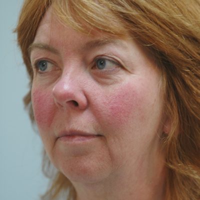 Ponytail Facelift before and after, case 39, view 3 (before)