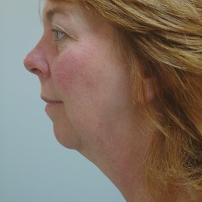 Ponytail Facelift before and after, case 39, view 4 (before)