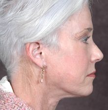 Ponytail Facelift before and after, case 40 (after)