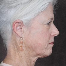 Ponytail Facelift before and after, case 40 (before)