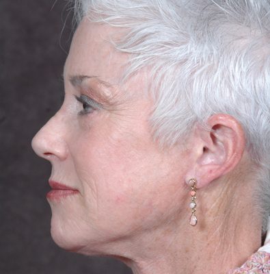 Ponytail Facelift before and after, case 40, view 3 (after)