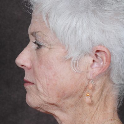Ponytail Facelift before and after, case 40, view 3 (before)