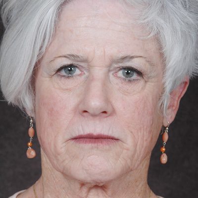 Ponytail Facelift before and after, case 40, view 4 (before)