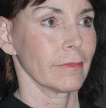 Ponytail Facelift before and after, case 41 (after)