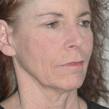 Ponytail Facelift before and after, case 41 (before)